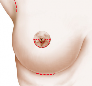 breast augmentation scars